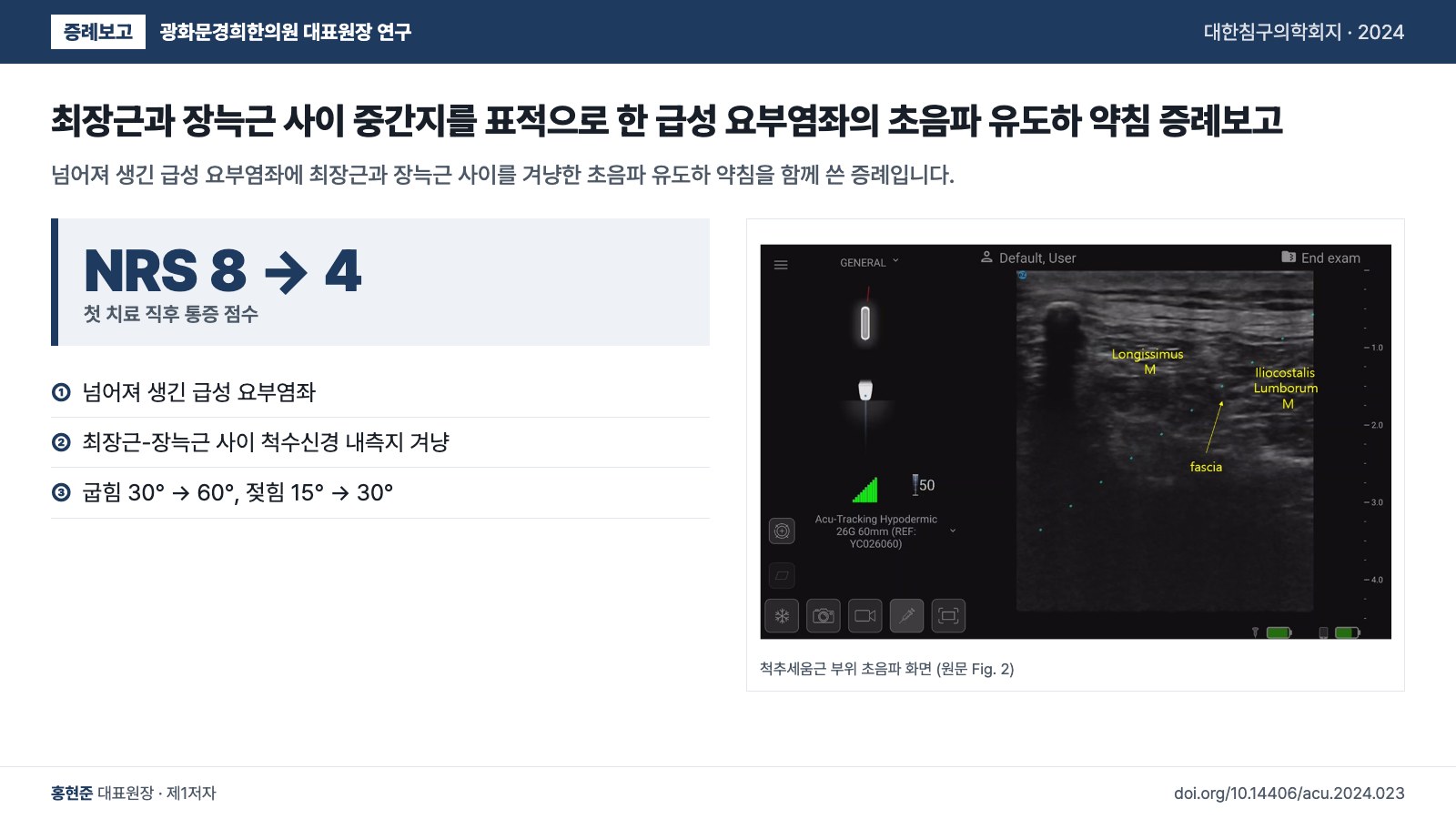 최장근과 장늑근 사이 중간지를 표적으로 한 급성 요부염좌의 초음파 유도하 약침 증례보고 — 넘어져 생긴 급성 요부염좌에 최장근과 장늑근 사이를 겨냥한 초음파 유도하 약침을 함께 쓴 증례입니다.