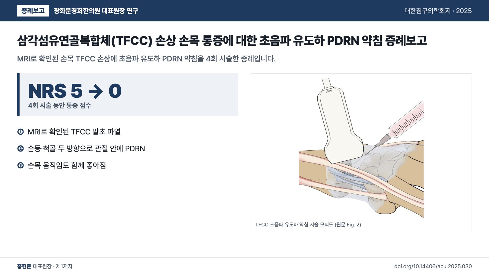 삼각섬유연골복합체(TFCC) 손상 손목 통증에 대한 초음파 유도하 PDRN 약침 증례보고 — MRI로 확인된 손목 TFCC 손상에 초음파 유도하 PDRN 약침을 4회 시술한 증례입니다.